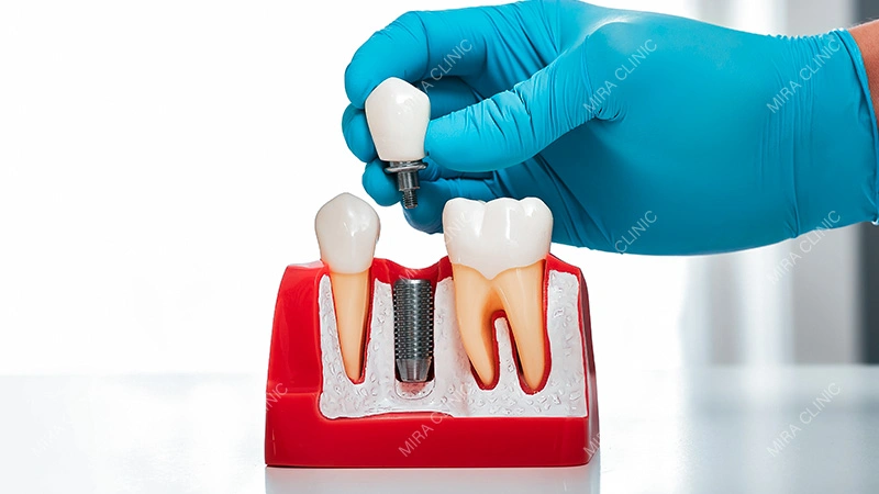 implant treatment